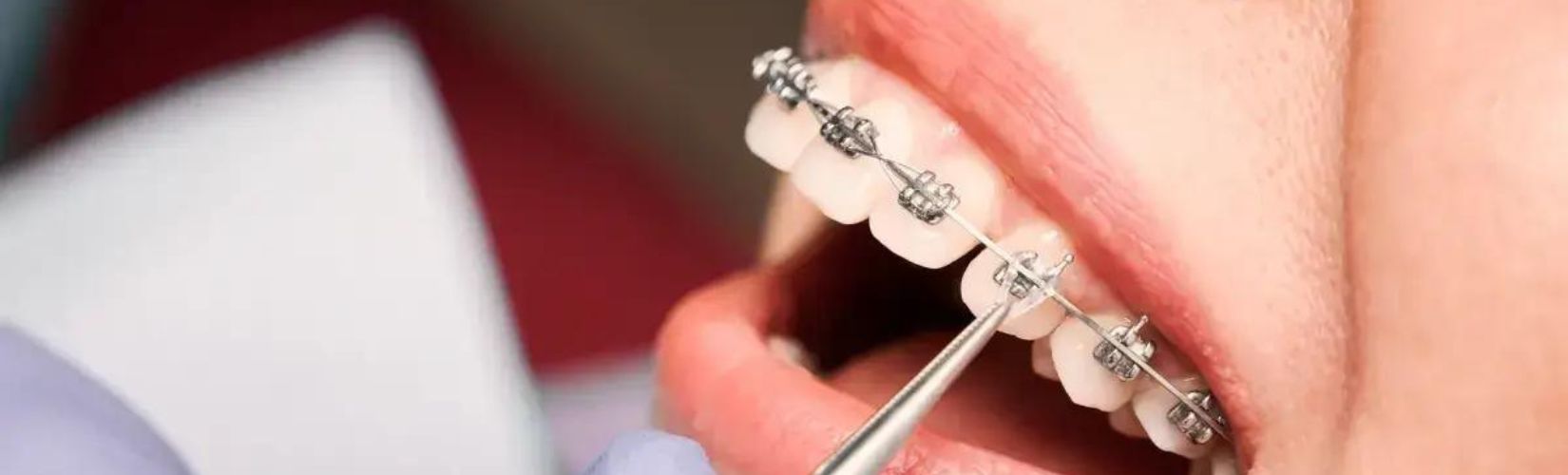 close up of metal braces | La Belle Dental Clinic