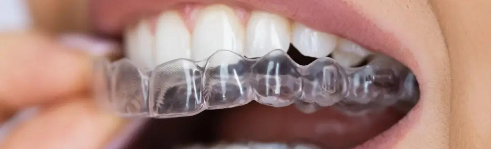 close up of invisalign aligners | La Belle Dental Clinic